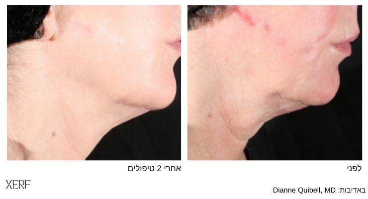 הידוק עור הצוואר — מבט צד